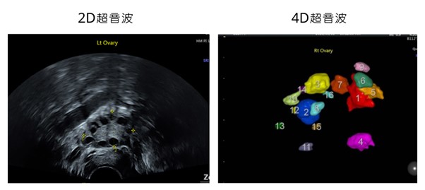 4D超音波和2D超音波中的卵巢影像 4D超音波和2D超音波中的卵巢影像