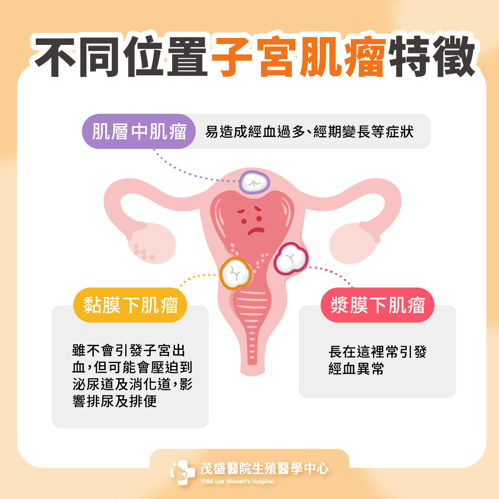 不同位置子宮肌瘤特徵