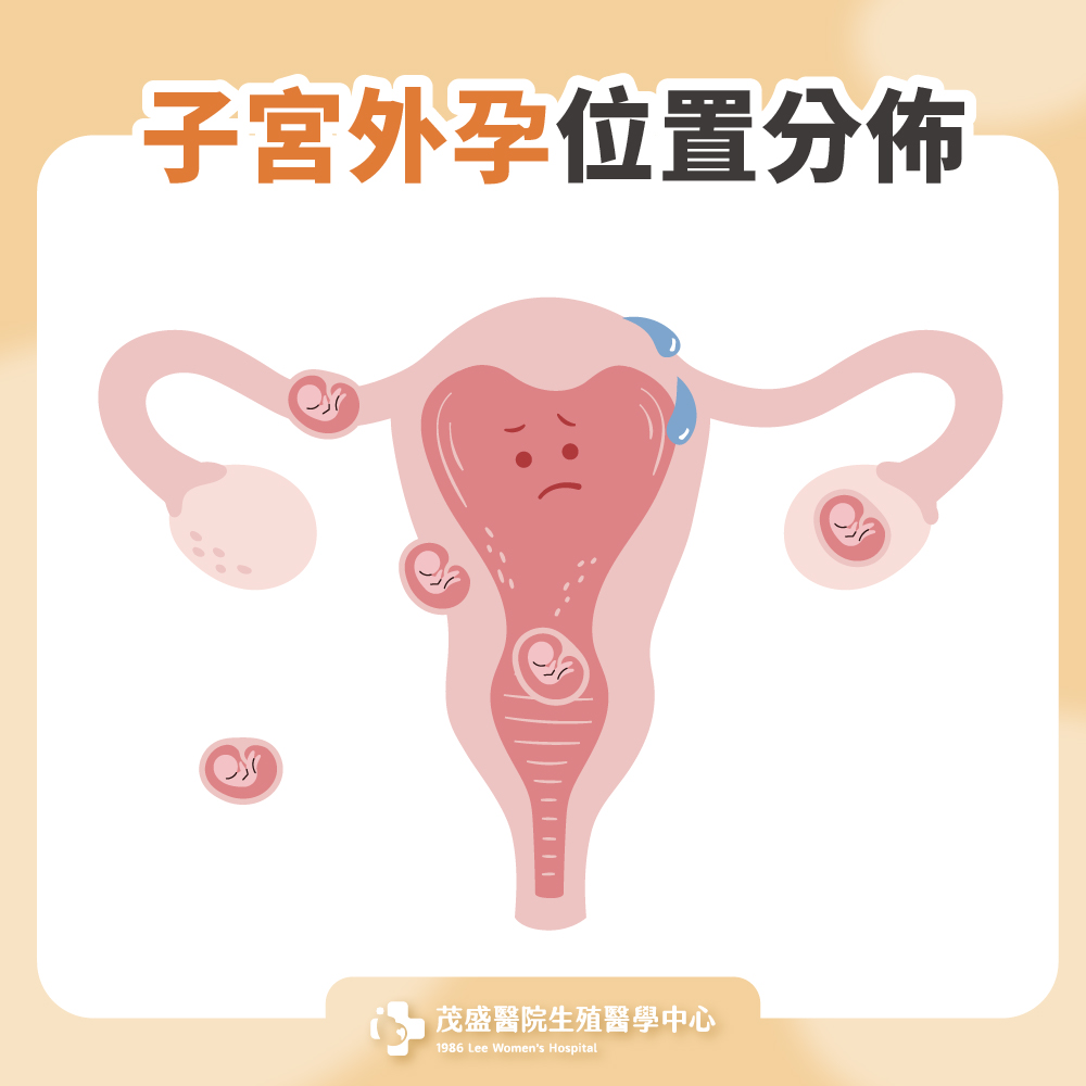 子宮外孕位置分佈