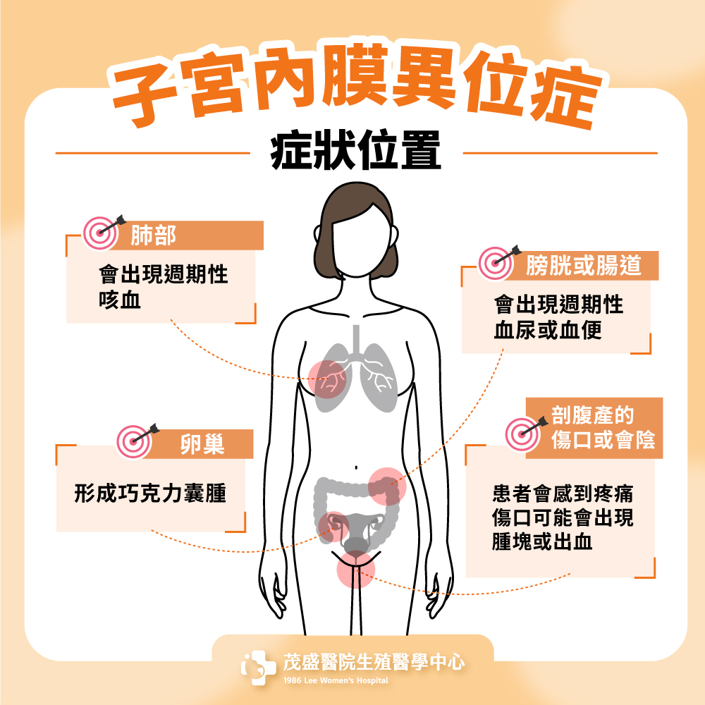 子宮內膜異位症症狀位置