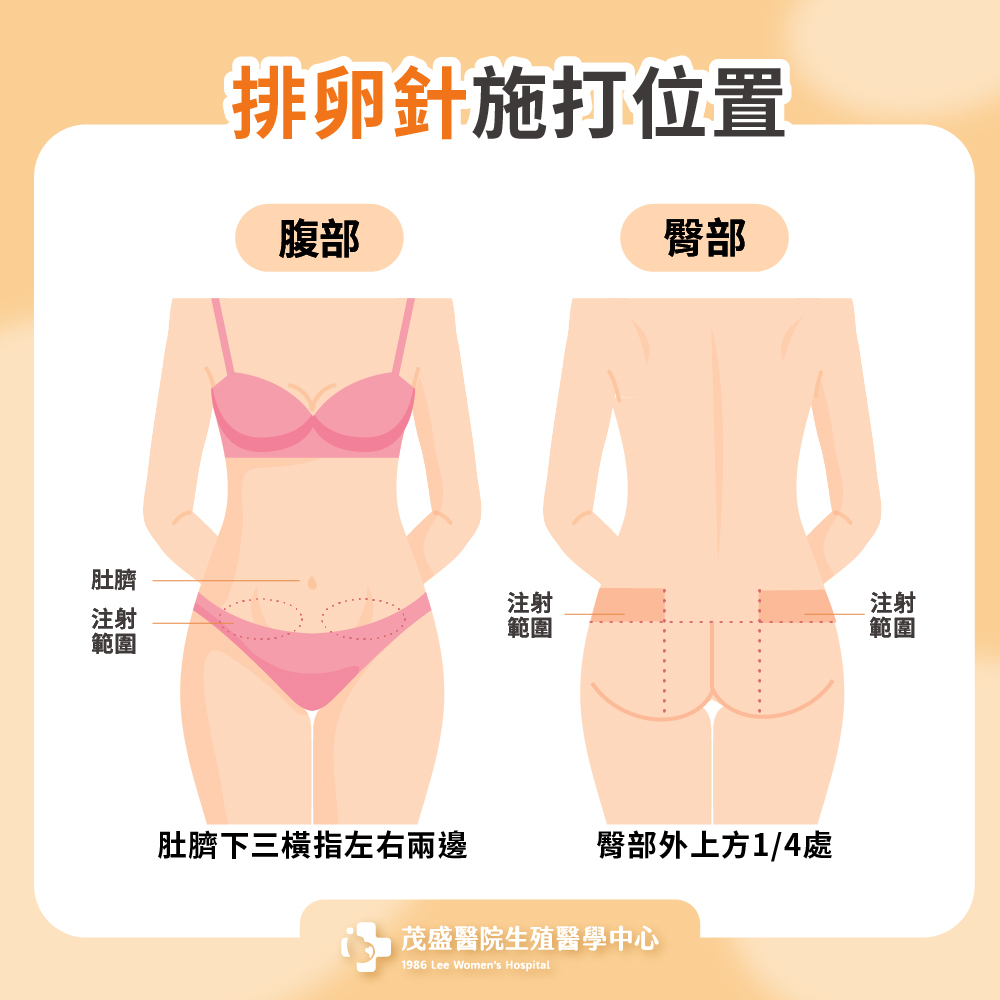 施打排卵針位置